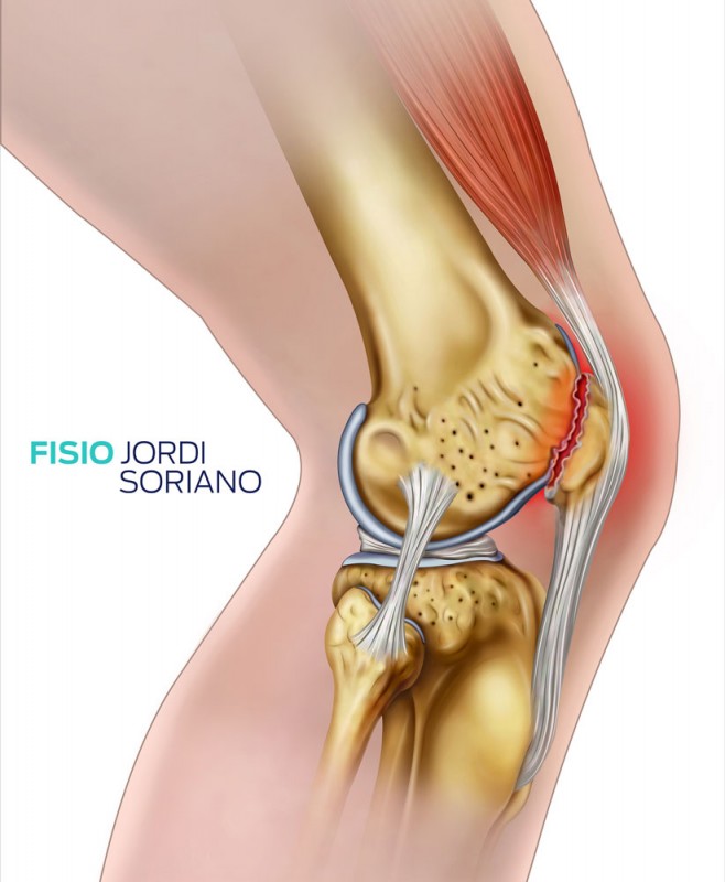 Tendinitis Rotuliana S Ntomas Y Tratamiento Fisio Jordi Soriano